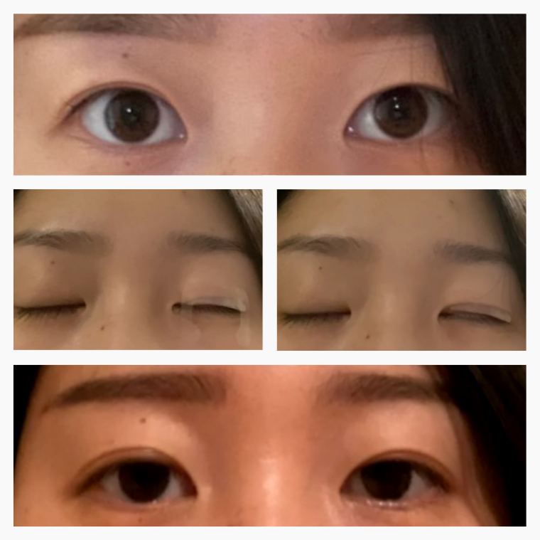 Optifold EyelidShaping™ Tapes (Standard Pack)