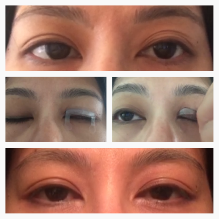 Optifold EyelidShaping™ Tapes (Standard Pack)