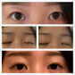 Optifold Eyelid Tapes - Create Double Eyelids + Fix Uneven, Droopy, Hooded Eyelids