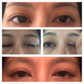 Guaranteed Double Eyelids – Personalized Advising Service