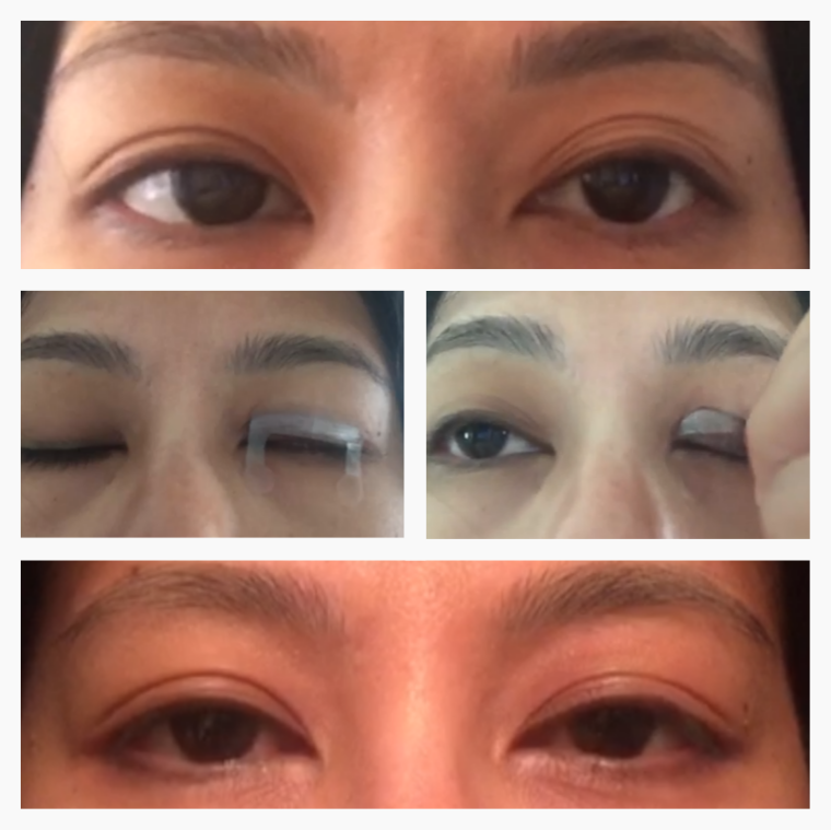 Optifold Eyelid Tapes - Create Double Eyelids + Fix Uneven, Droopy, Hooded Eyelids